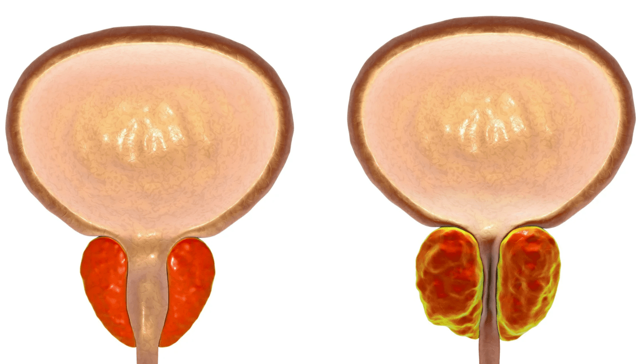 Unsa ang prostatitis