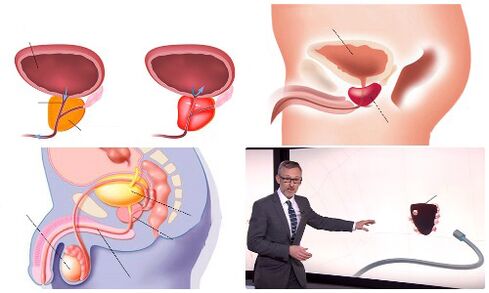 himsog ug masakiton nga prostate